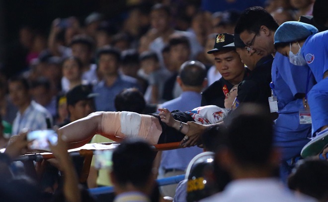 Nữ CĐV phải mổ 2 lần vì dính phải pháo sáng từ CĐV Nam Định